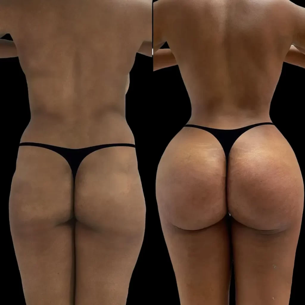 Hyacorp Fillers Treatments in Dubai: A Complete Guide to Body Contouring hyacorp fillers in Dubai