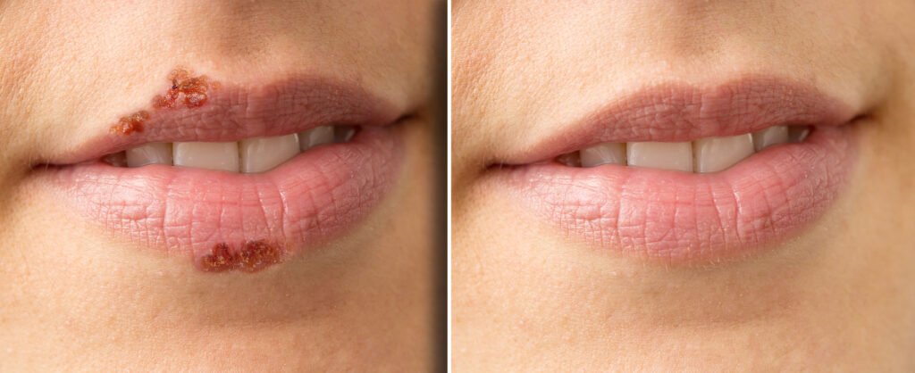 cold sores treatment