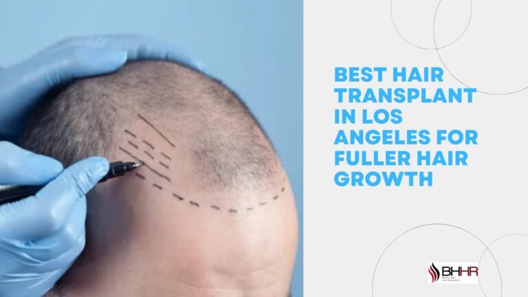 best hair transplant in los angeles