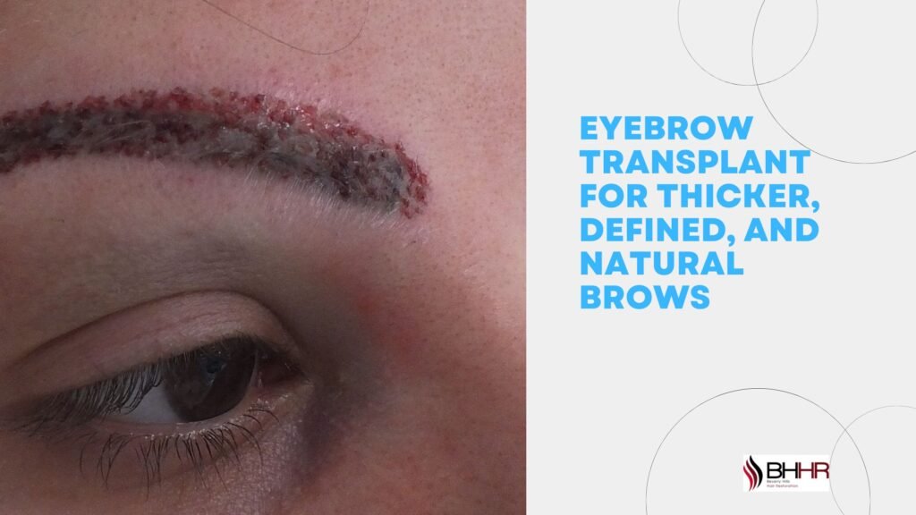 Eyebrow Transplant for Thicker, Defined, and Natural Brows eyebrow transplant