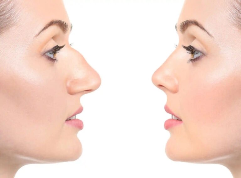Nose Surgery in Dubai: Combining Artistry with Medical Innovation Rhinoplasty in Dubai