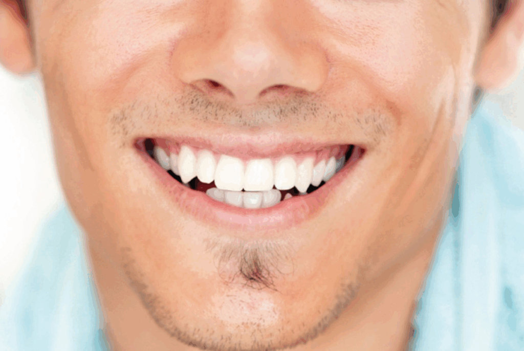 Full dental implants