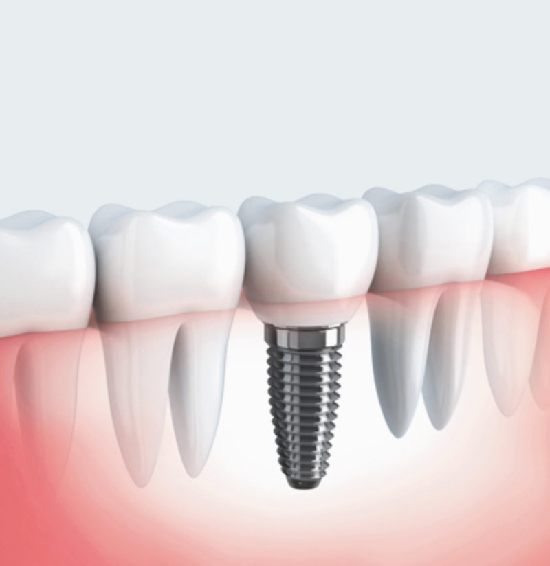 dental implant London
