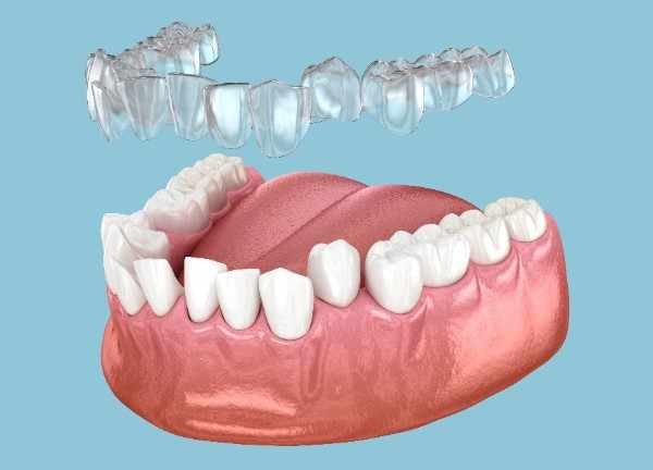 dental implants West Bromwich