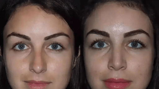 Elevating Facial Harmony with Expert Rhinoplasty in Dubai rhinoplasty in dubai
