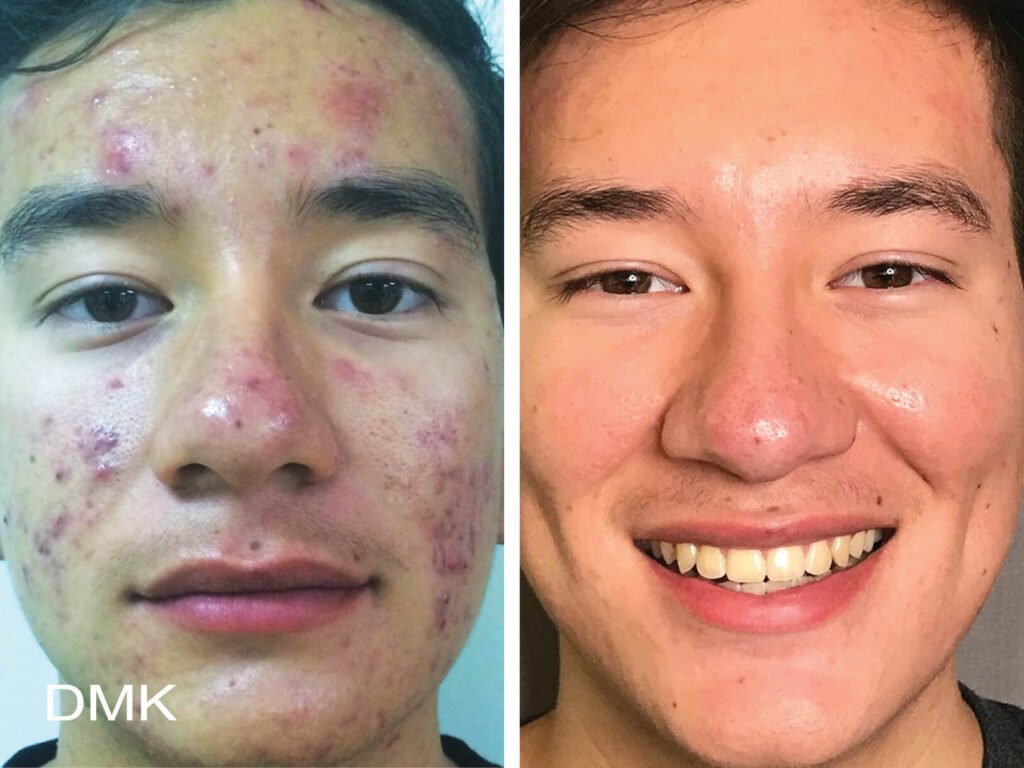 Rosacea behandling i Malmö