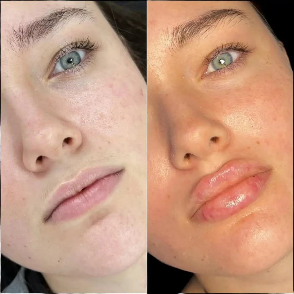 Fillers Treatments in Dubai: The Ultimate Solution for Cheek Enhancement Fillers in Dubai