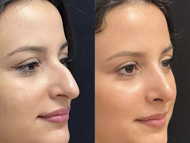 Why Nose Surgery in Dubai Is in High Demand Rhinoplasty in Dubai