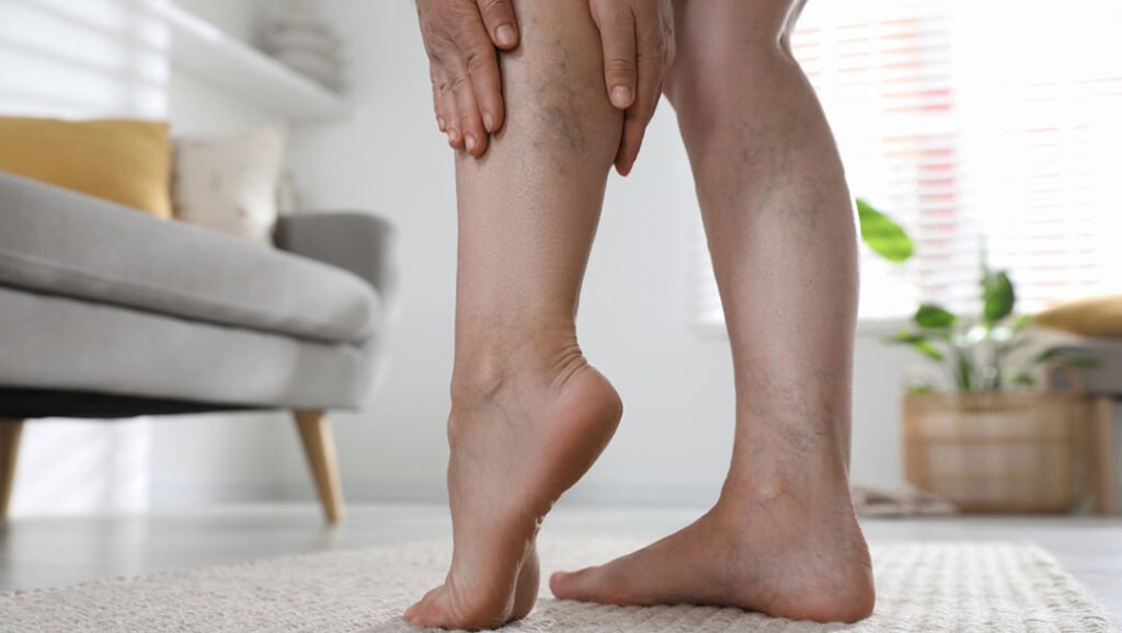 Latest Technology for Spider Vein Removal Manchester Spider Veins In Manchester