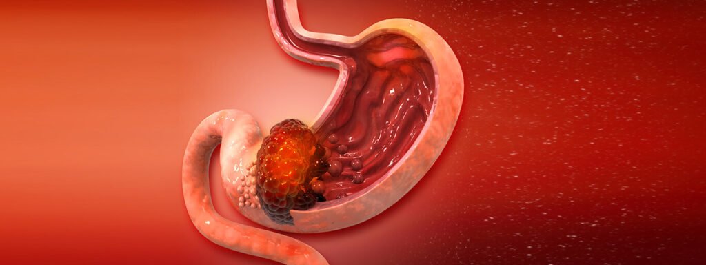 Survival Rates & Early Detection: What Delhi Experts Say About Stomach Cancer Survival Rates & Early Detection: What Delhi Experts Say About Stomach Cancer